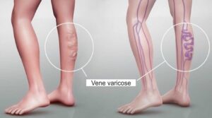 vene-varicose-2