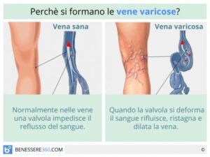 vene-varicose-alle-gambe_700x525